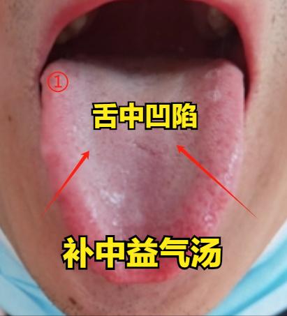 养脾胃？记好这个思路：舌面凸起用木香顺气，舌面凹陷用补中益气
 
临床多年经验来