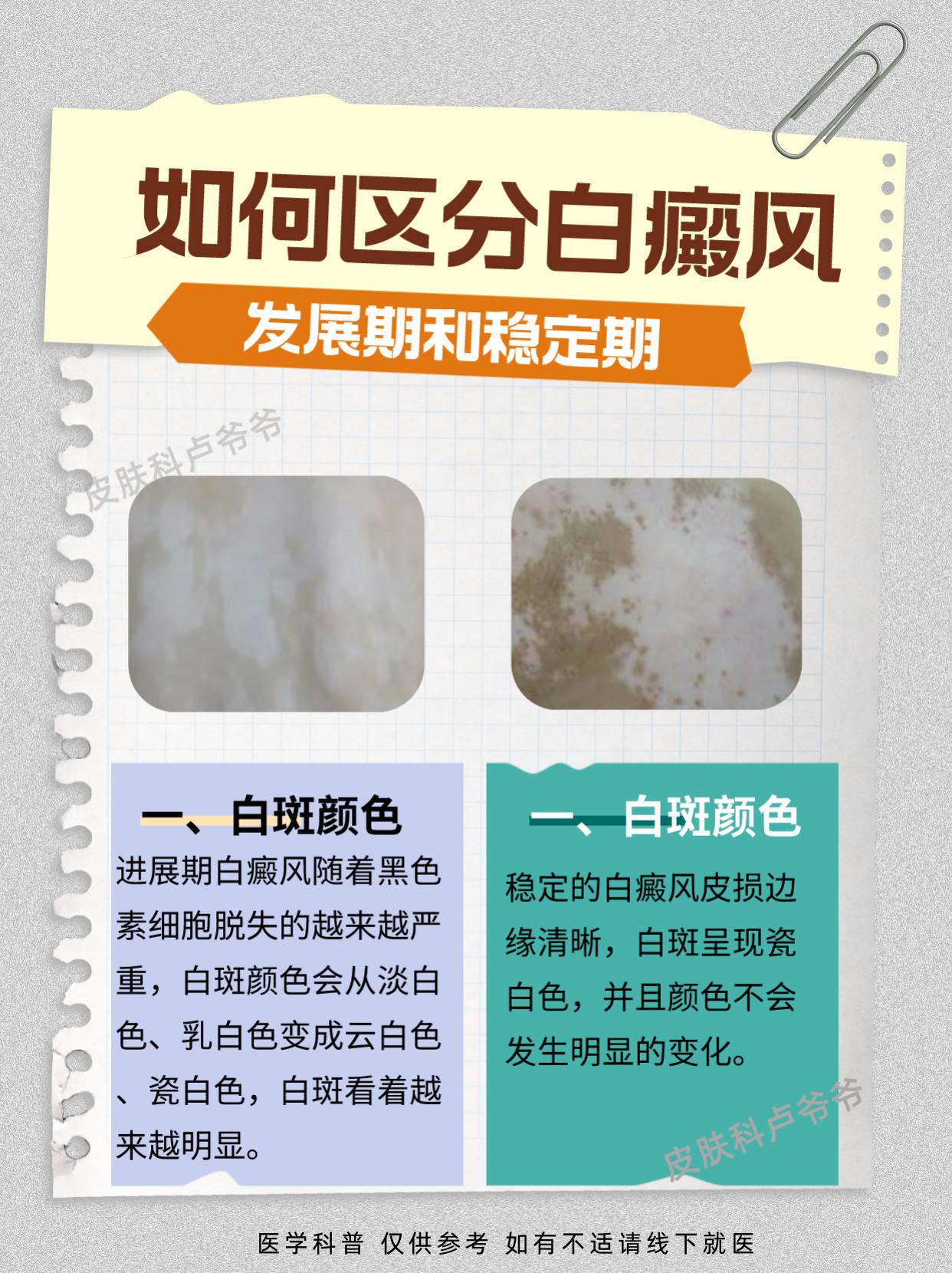 如何区分白癜风的发展期和稳定期？江西