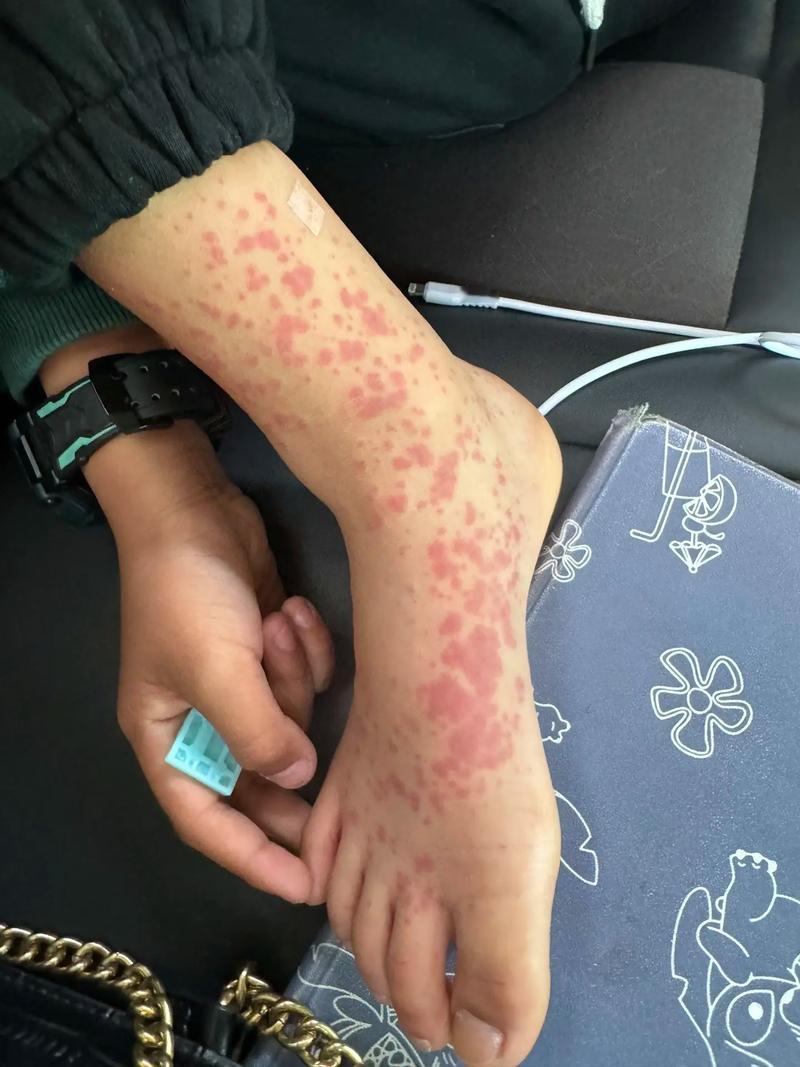 血小板低能自己恢复吗?说说我自己的亲身经历吧，有一天早上我从床上爬起来，突然发现
