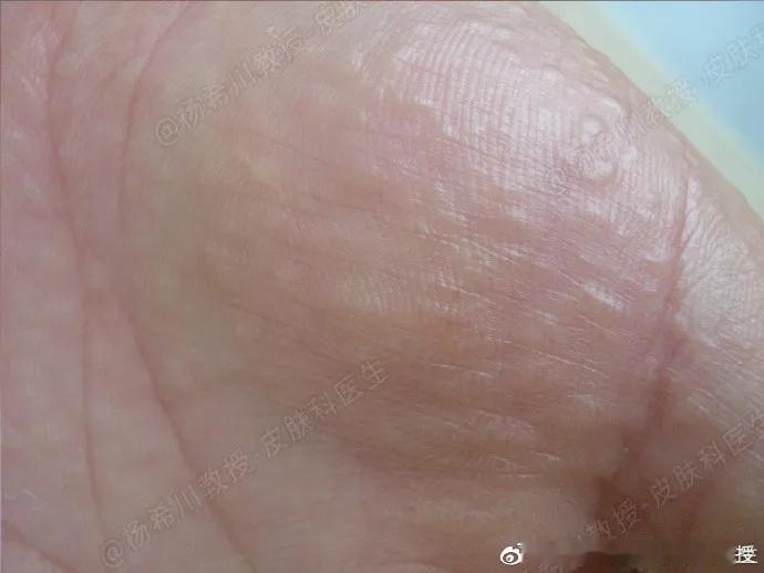 日常生活中如何预防又痒又疼的汗疱疹？①减少刺激有些人的汗疱疹跟接触洗衣粉、肥皂或