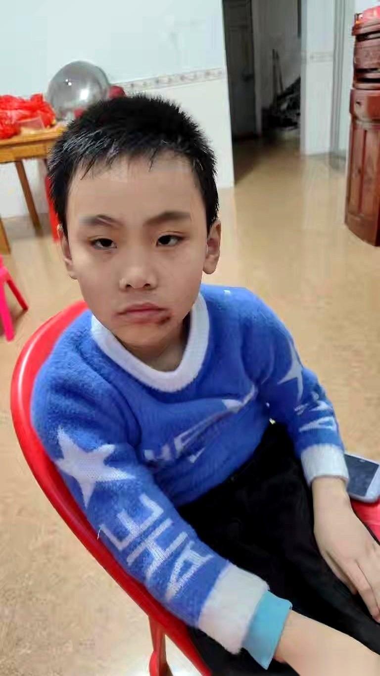 11周岁的自闭症儿子从同班女同学的书包里拿了20块钱，转身就买东西全花光了。
对