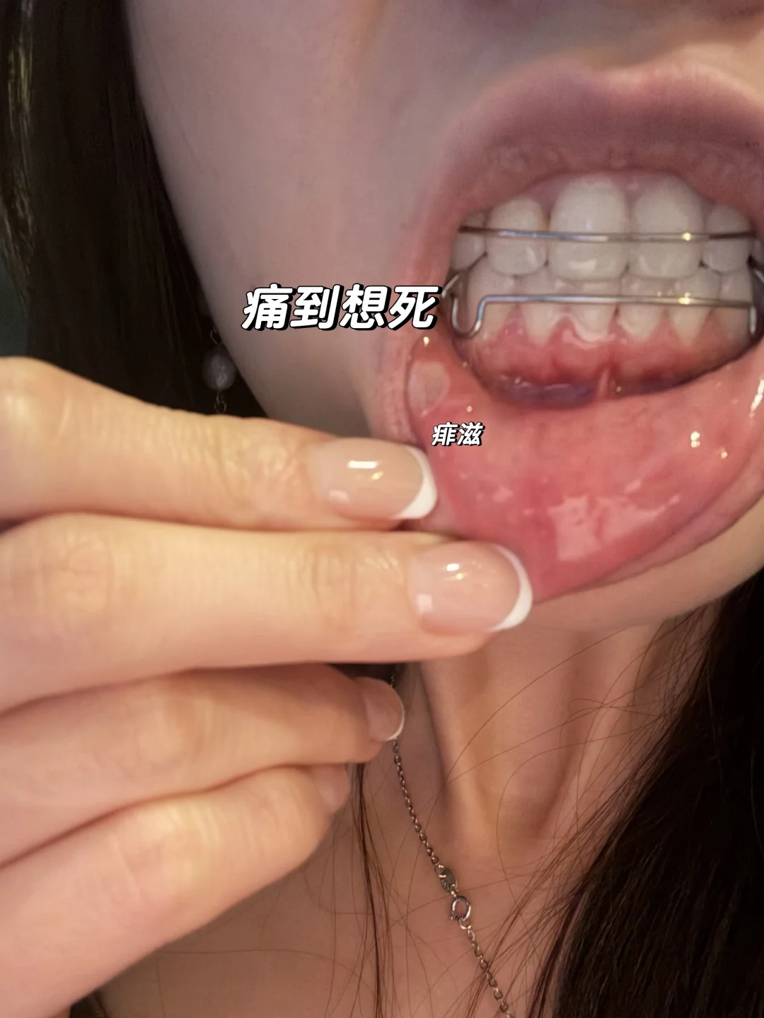 你们那边溃疡怎么说