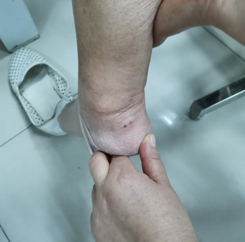 被毒蛇咬伤可不能慌！首先得保持冷静，减少受伤部位活动，过多运动可是会加速毒素扩散