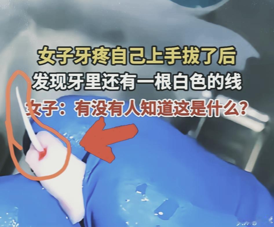 牙疼不是病，疼起来真要命！疼到忍无可忍，直接自己动手拔牙！结果拔出的牙里藏着一根