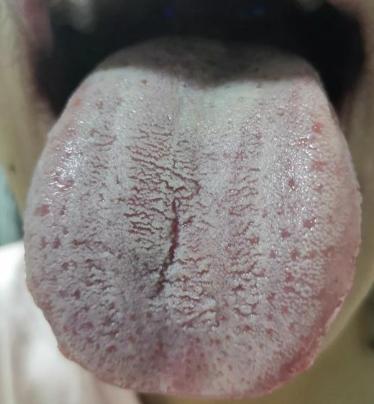 这样的舌头，再怎么补都没有用，找不到关键点，纯属白费功夫！
 
主诉：总是会胸口