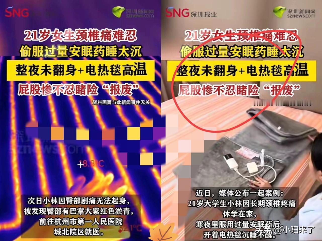 浙江杭州，一女子开着电热毯睡觉，因服用过量安眠药，所以睡得很沉，一夜没翻身，不仅