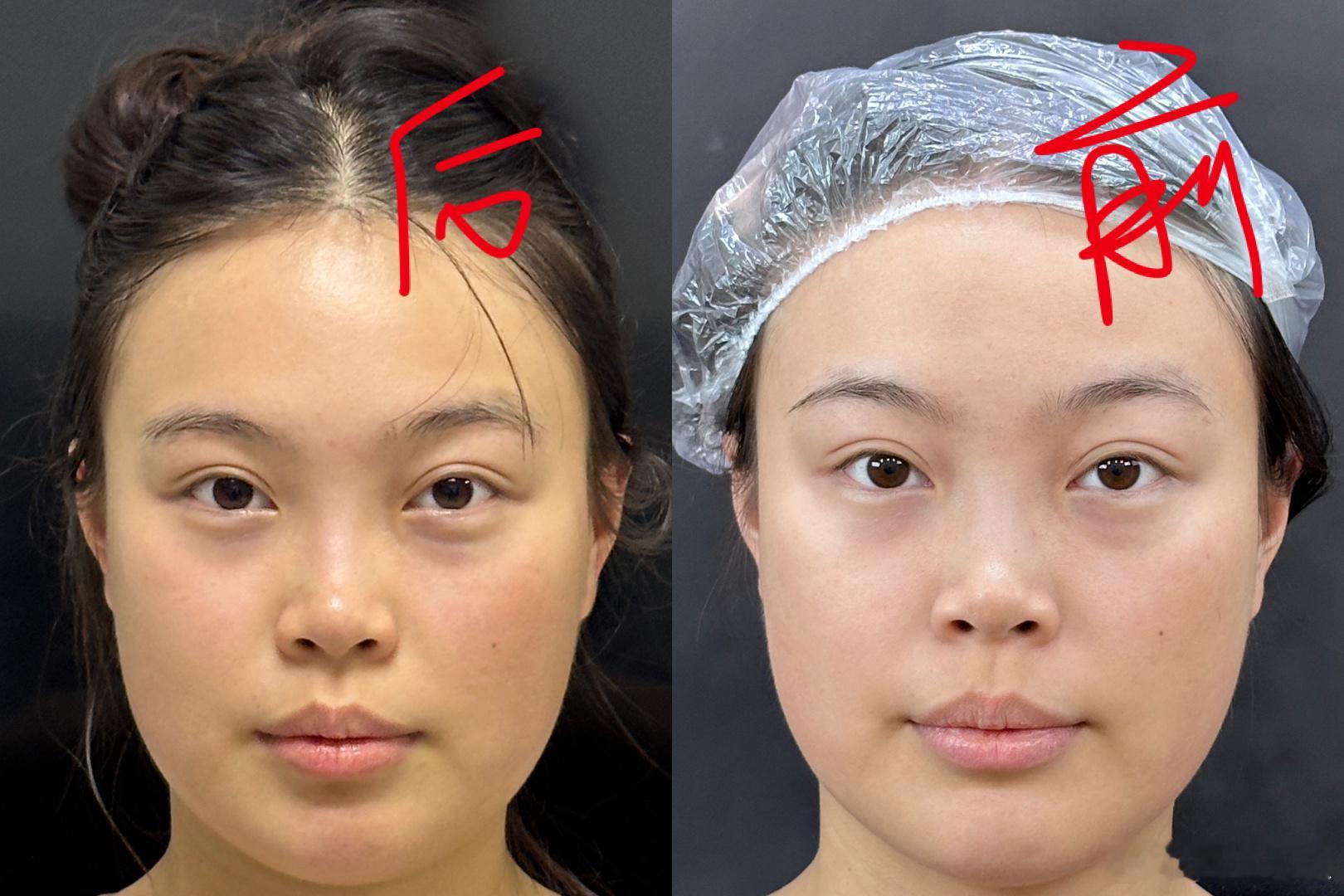超声炮一个月了吧。家人们 感觉没啥变化 ​​​