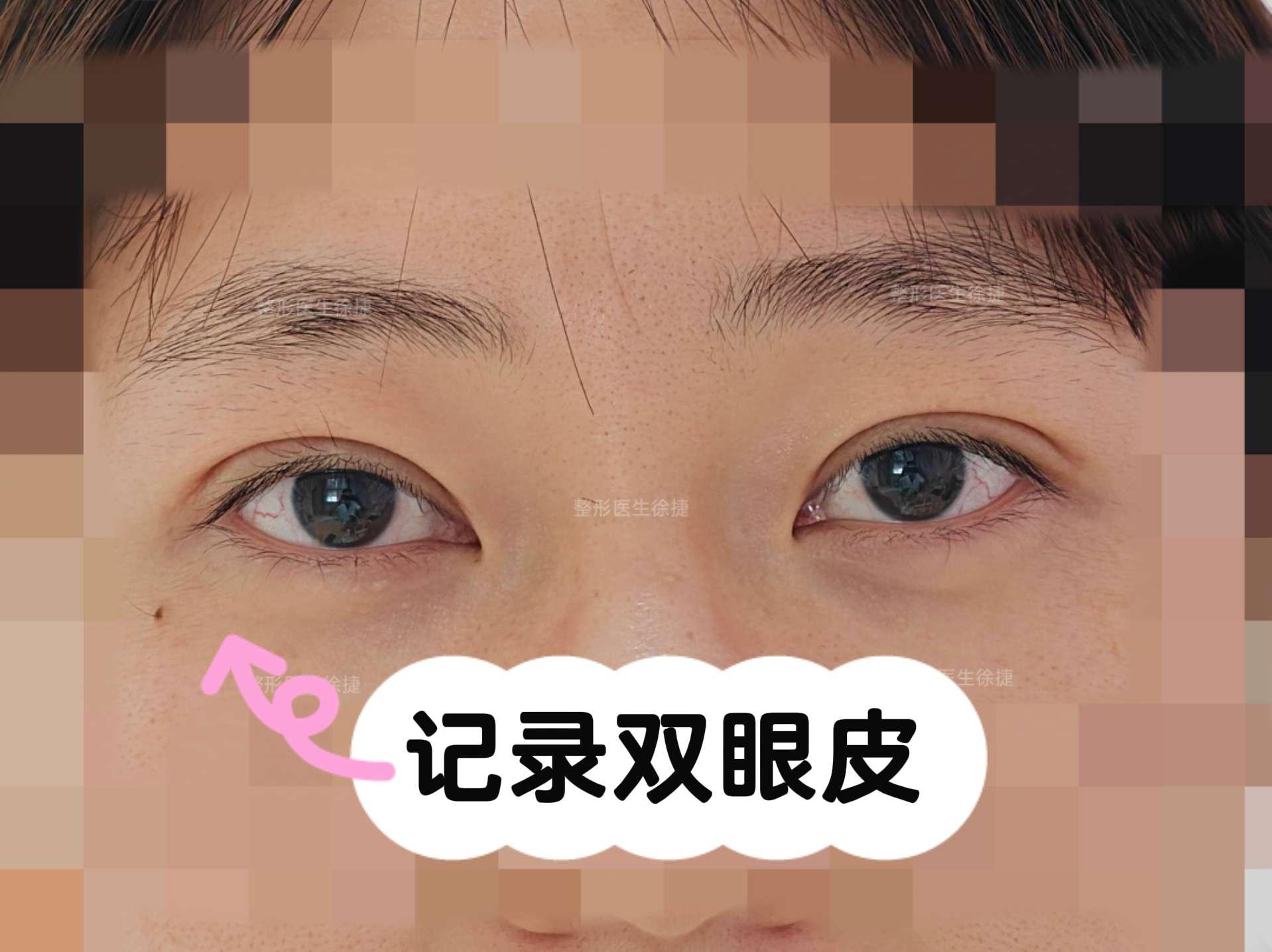 这是你喜欢的蒜皮吗。7月15日做的蒜皮回来复诊了，你觉得恢复的怎么样