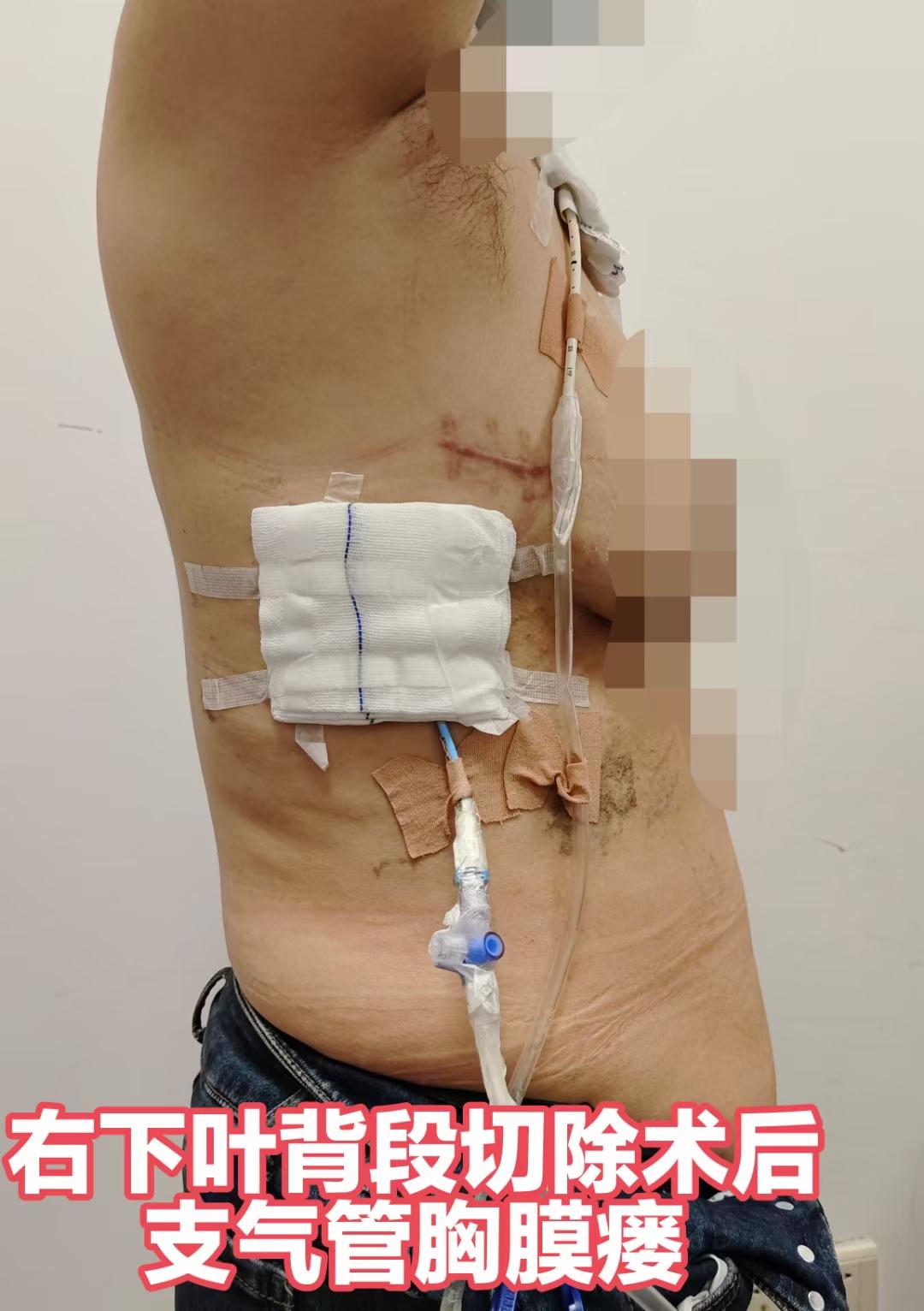 支气管胸膜瘘总是有可能发生，这位病友，主管医生直接转诊我院。早期处理...