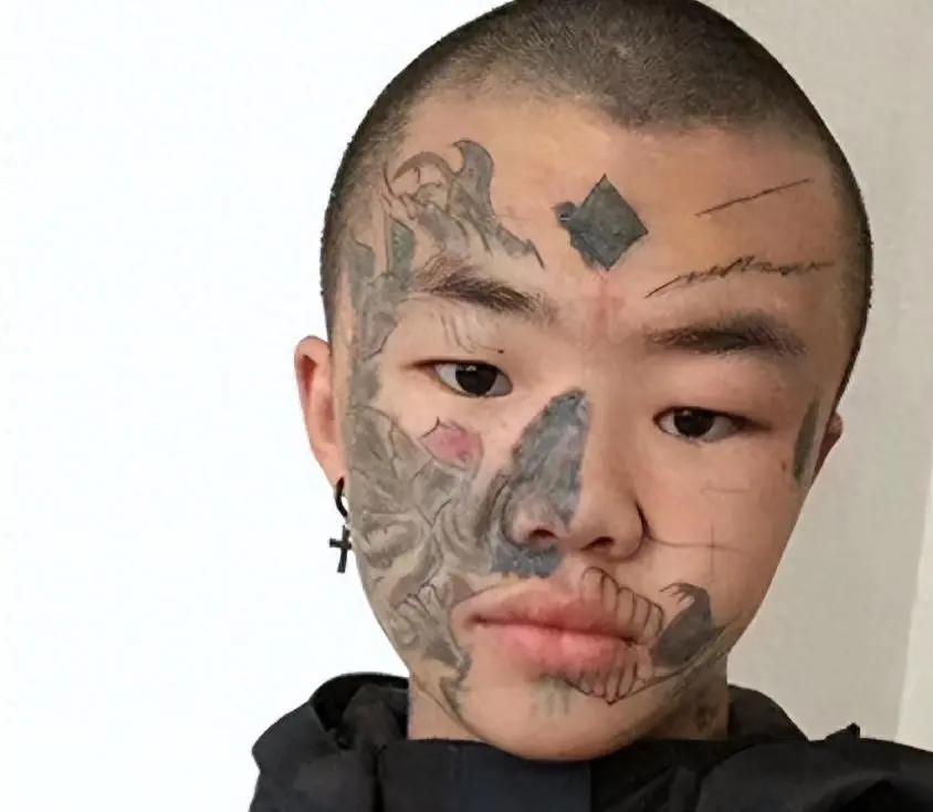 夏朝勇坐在治疗室的椅子上，额角还沾着术后冰敷的水渍，这是他第三次完成纹身清洗。工