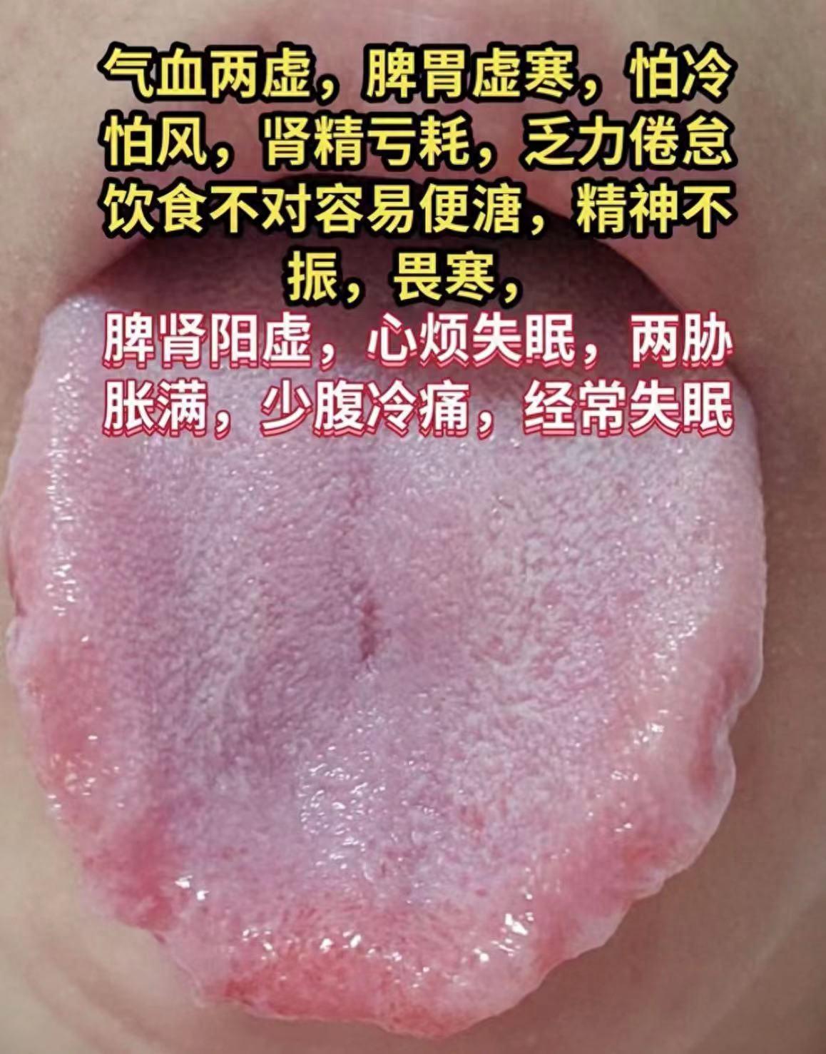 应粉丝要求分析舌诊，快看看你的舌象是哪个？

1、脾肾阳虚、气血两虚
症状：精神