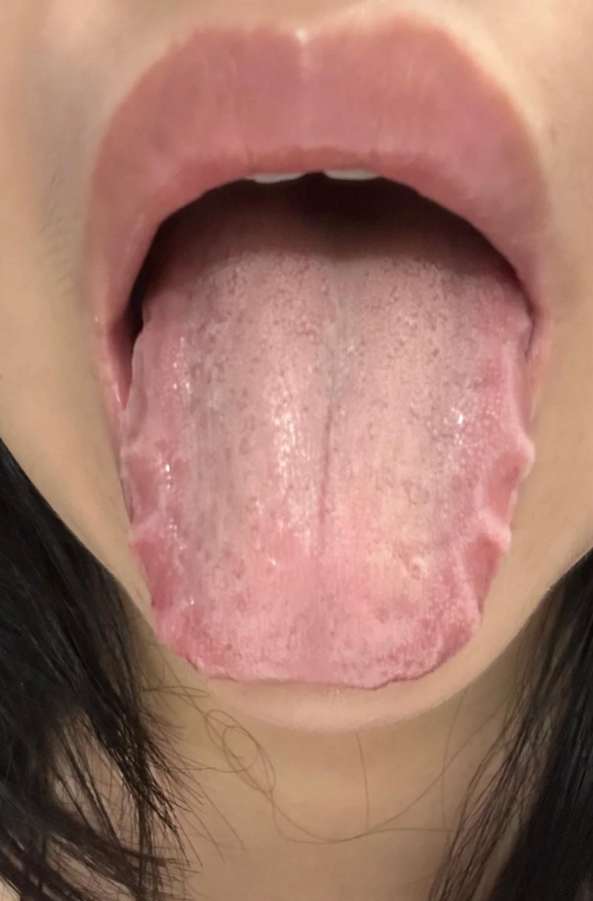 肝郁的真不轻，这舌变成啥样了，你到底干嘛啥了
碰见这种的舌边，肝郁最起码5年起步
