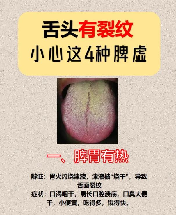 舌头有裂纹，小心这 4 种脾胃问题