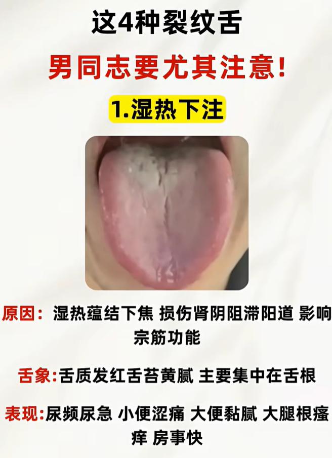 舌面裂纹暗藏体虚问题，从舌象分辨四种下焦亏虚证型