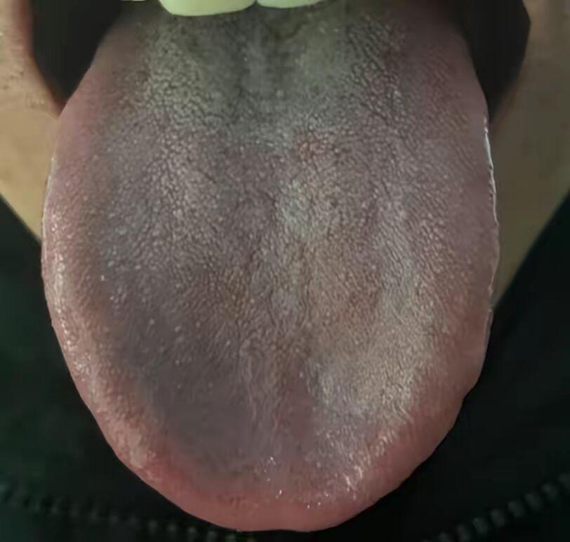 食欲不振腹胀频，温肾健脾双管齐下！
患者自述：患有慢性胃炎已达三年之久，日常感到