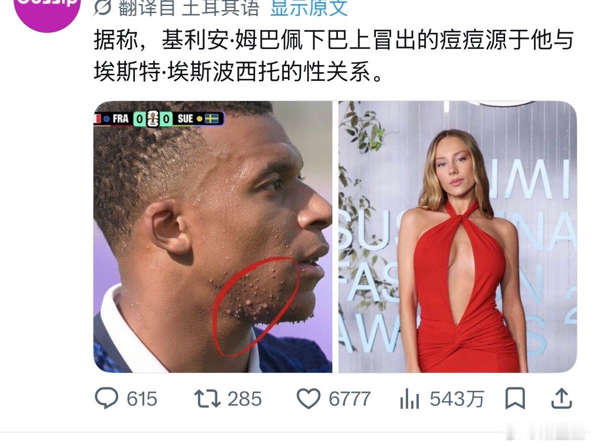 英格兰队员疑似hiv感染…. 