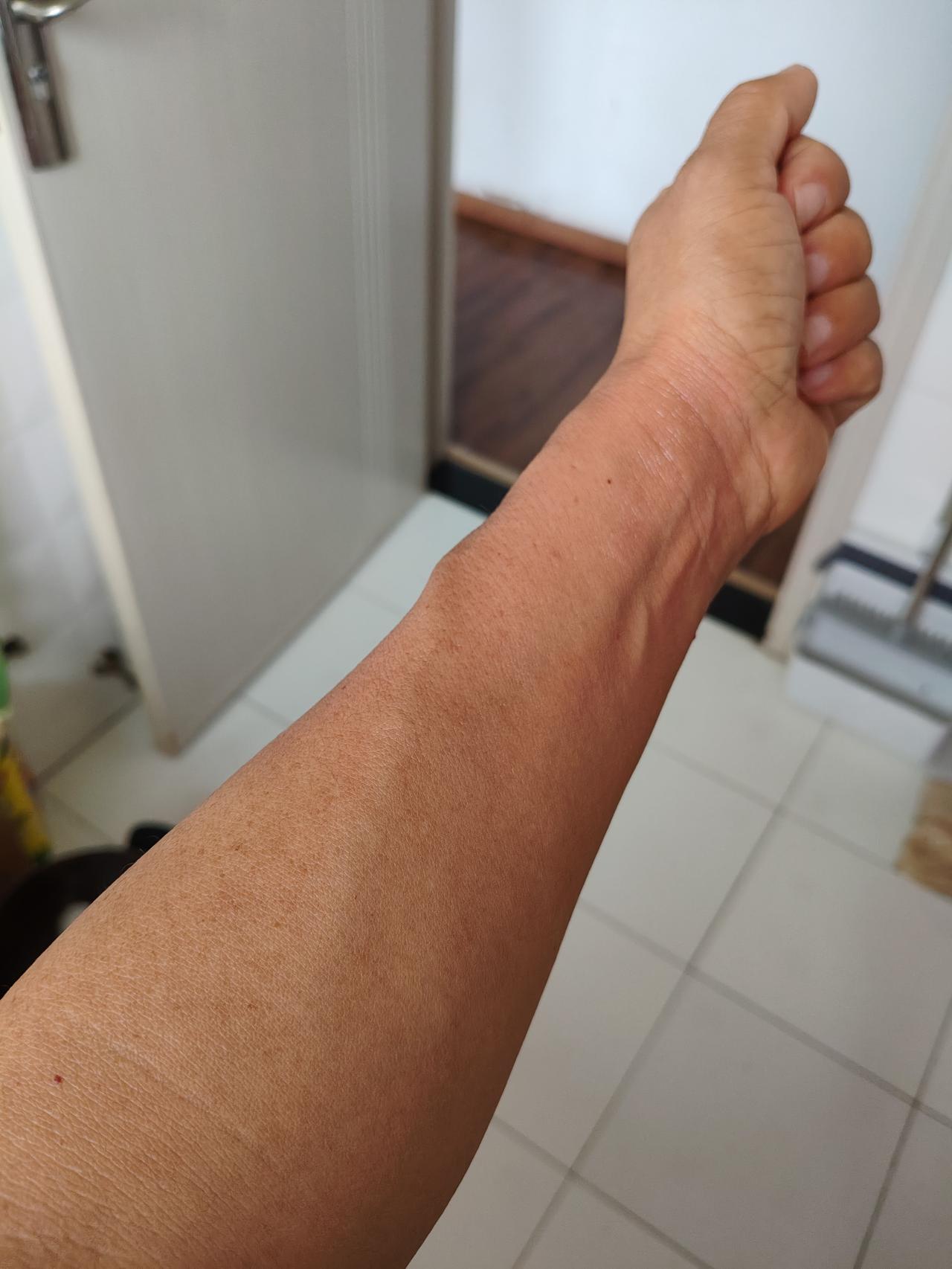 做饭不小心，一锅七八十度的热水浇在了手臂上，皮肤立马就红肿了，冷水大概冲了十来分