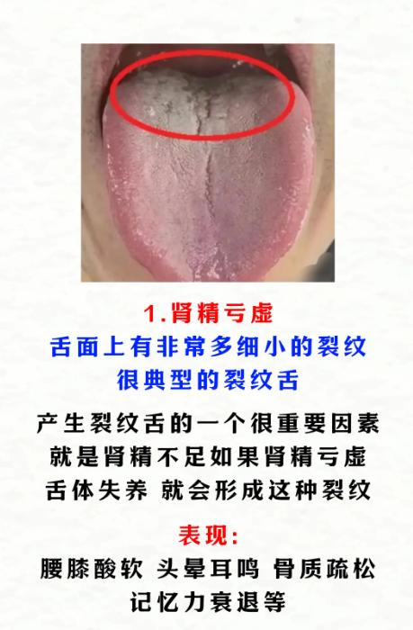 裂纹舌不一定是肾精亏虚，这 4 种情况别搞混了
