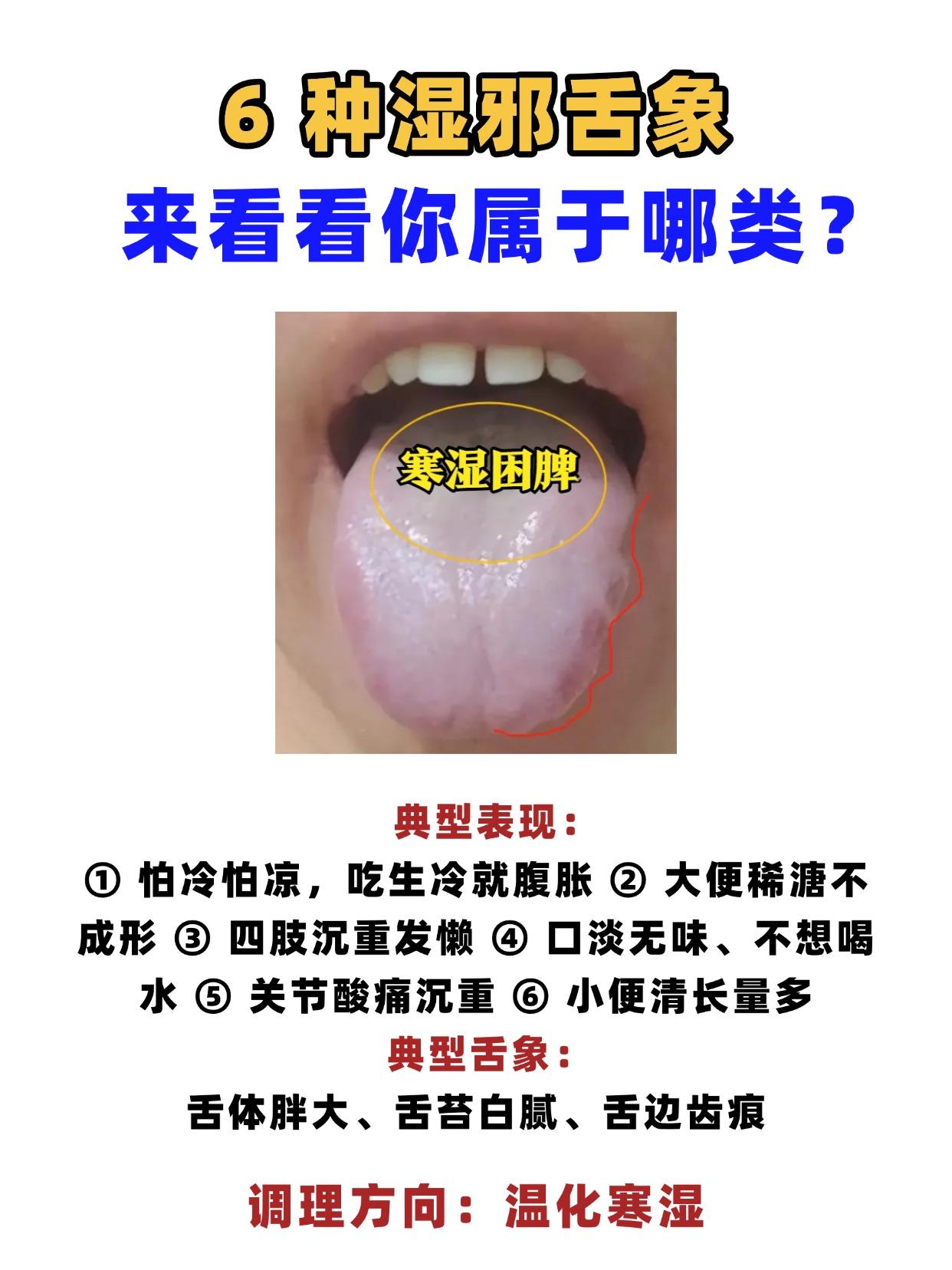 6种湿邪舌象，来看看你属于哪类?

一、寒湿困脾
典型表现：怕冷怕凉，吃生冷就腹