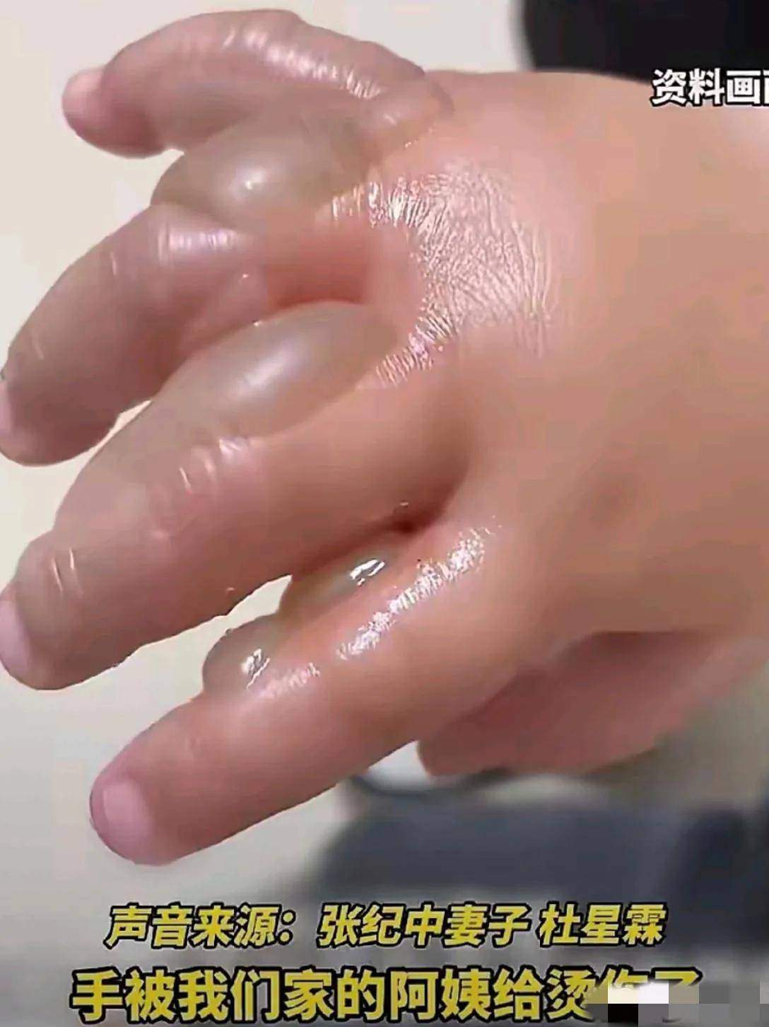 张纪中与杜星霖9个月的孩子被保姆烫伤，燎泡触目惊心，看上去真让人心疼呀！估计这个