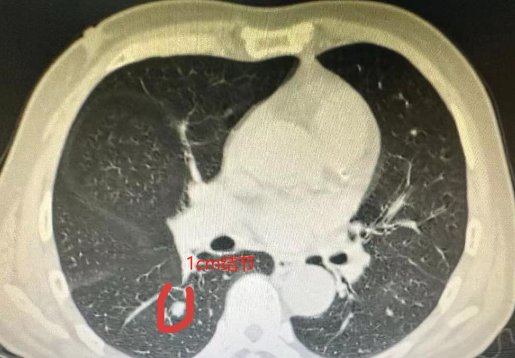 一年时间，肺结节长到4cm！速度真有这么快？患者69岁去年因为感冒去做CT，发现