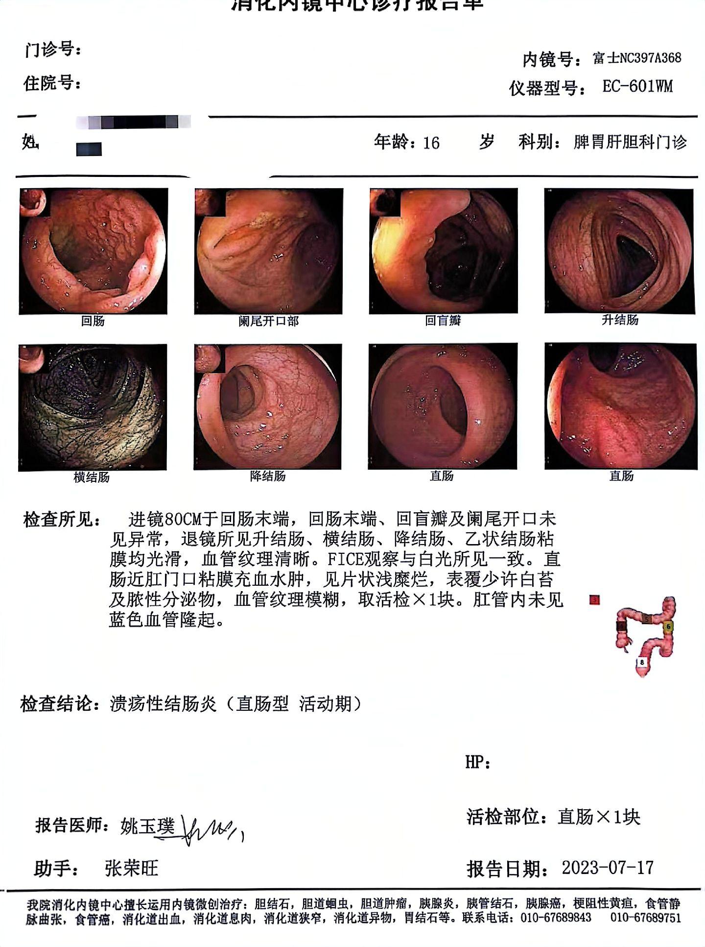 溃疡性直肠炎一定要用栓剂才能好吗？根据国内外指南，溃疡性直肠炎，首选栓剂治疗，如果栓剂效果不佳加上口服美沙拉嗪治疗。
但是临床上很多患者排斥使用栓剂，口服美沙拉嗪又浓度无法达到直肠，所以一部分患者效果较差。
当然国内外有溃结循证依据的草药也会有效果，但是不是随便开个汤药都能好的，汤药往往对于直肠效果欠佳。
