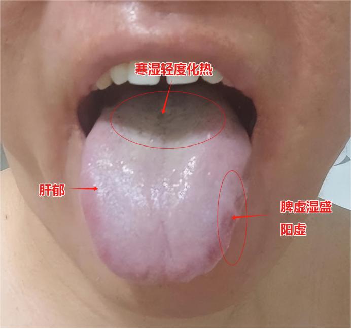 看这个舌象，虽然是脾虚湿气重，但切记不要用“健脾丸”！根本无用！
 
这个粉丝朋