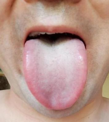 这个舌头一看真让人难受，哪哪都是病！

患者自述：咳嗽痰多，失眠多梦，在房事上也