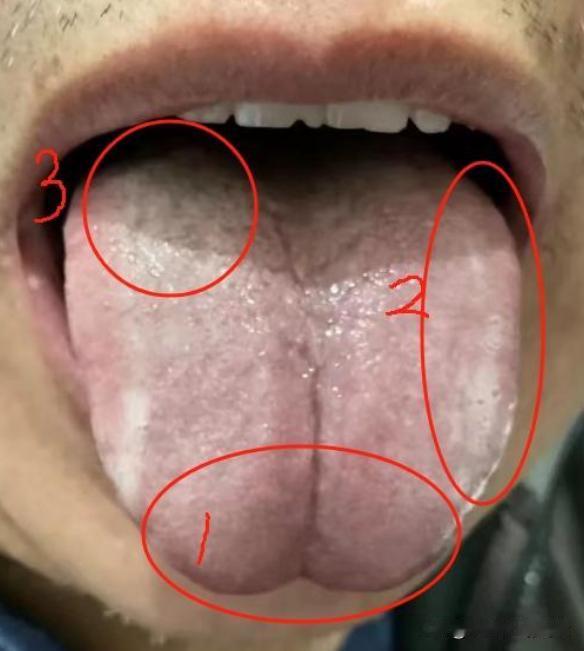门诊患者，43岁，拖得没办法了，才想起来看医生[吐血][吐血][吐血]
主诉：口