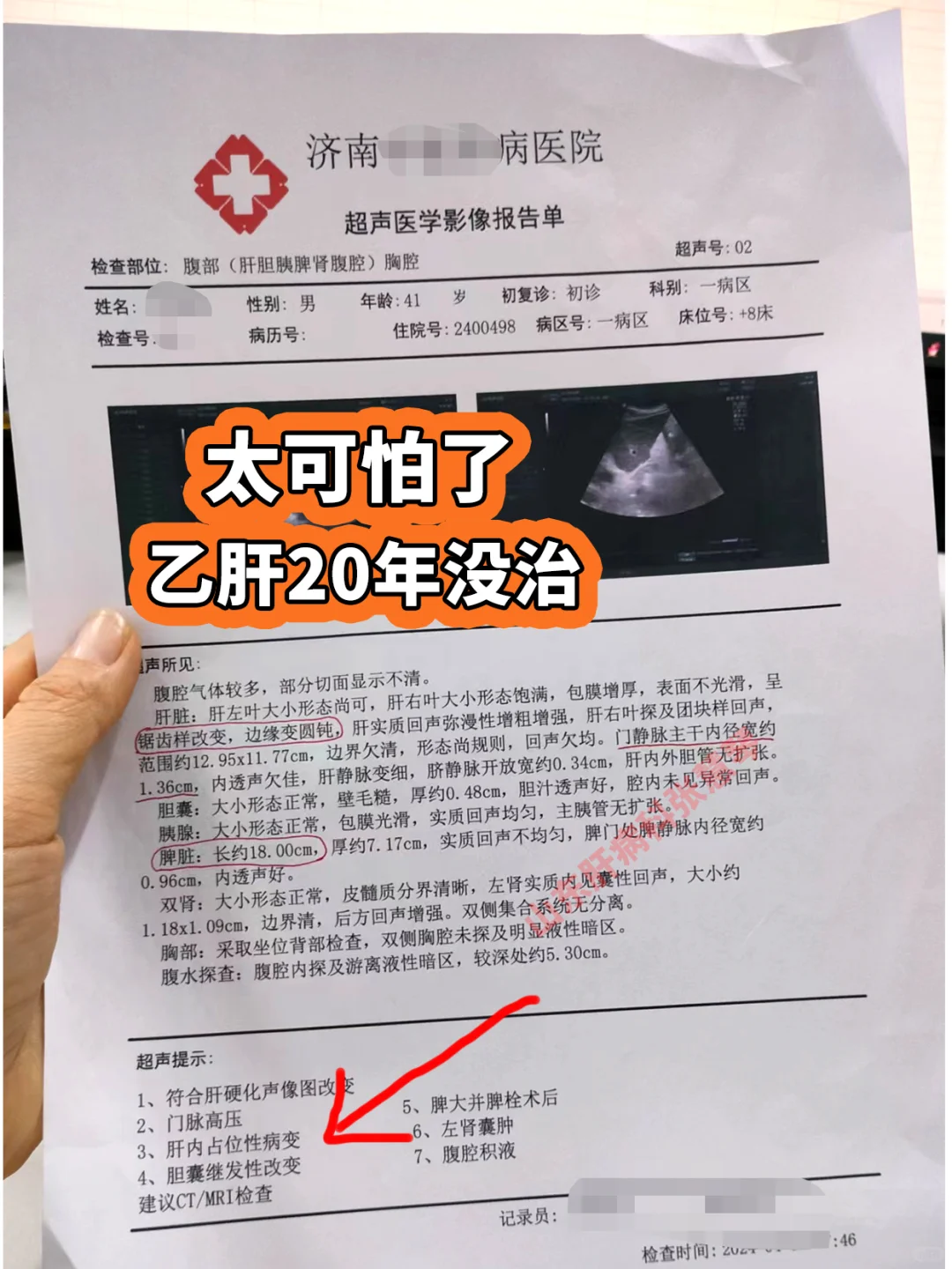 大家来看一下这位山东菏泽患者的B超多严重