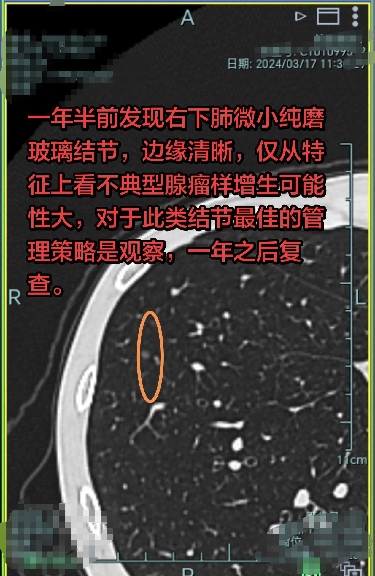 微小纯磨玻璃结就需要手术？一年半前发现右下肺微小纯结节，结节边缘清晰...