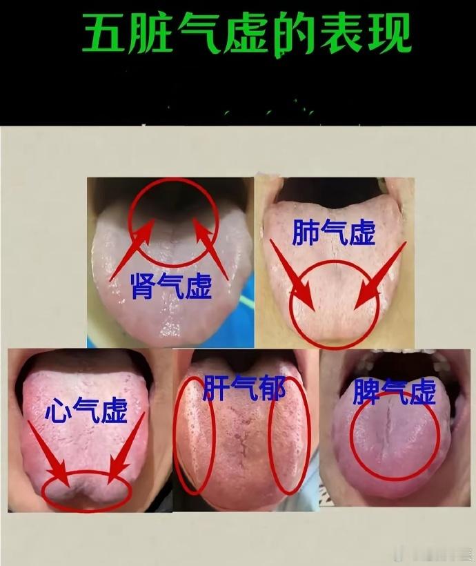 中医舌诊：看看你是哪里虚了？ 