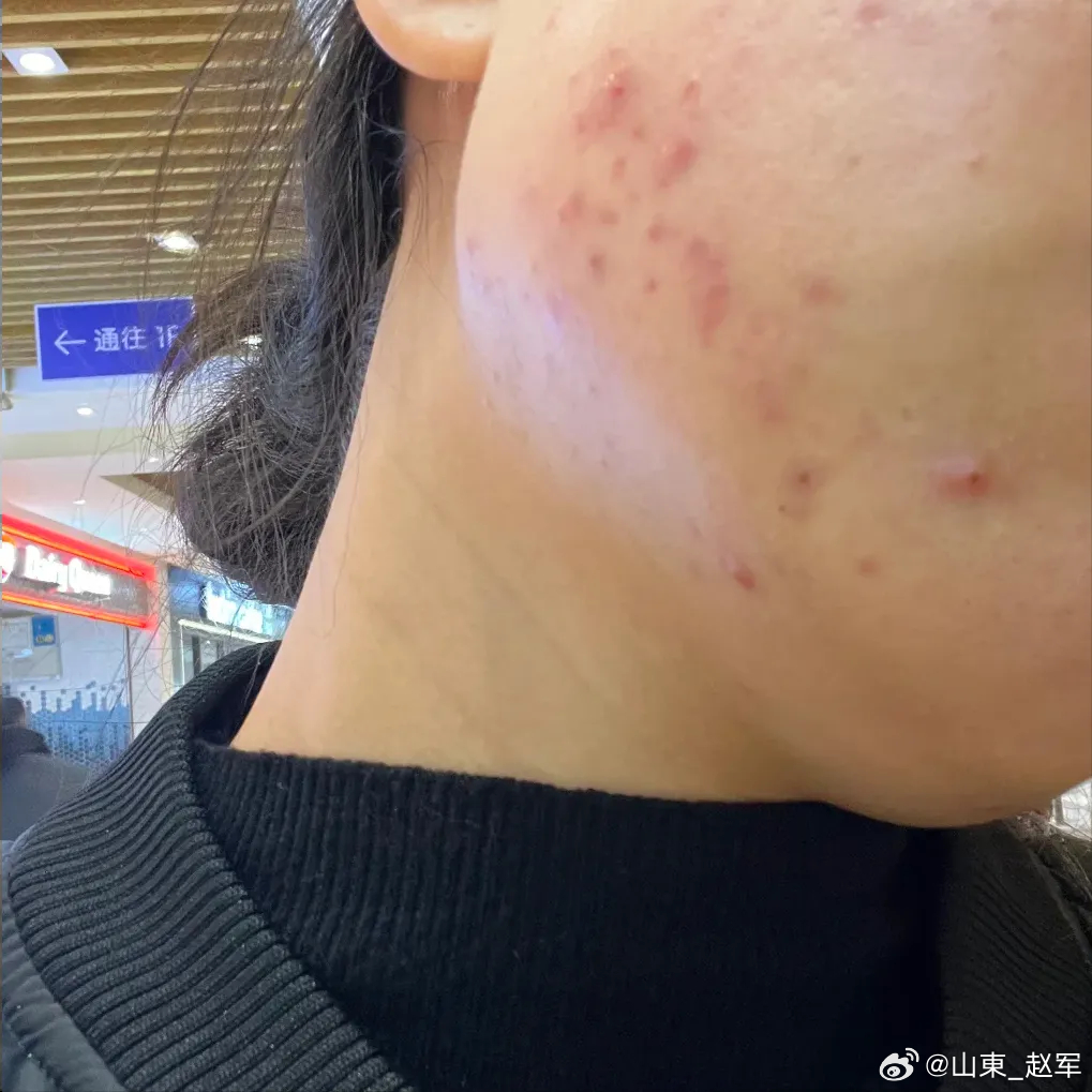 四味中药湿敷，搞定严重痤疮！脸上长痘是油脂堵塞毛孔，继发痤疮丙酸杆菌感染。与其长