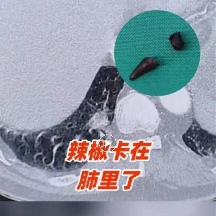 陕西西安 70 岁的张大爷，是个地道的 “辣控”，日常吃饭无辣不欢，一个月能吃掉