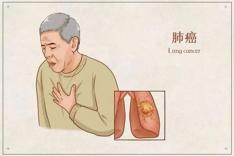 肺癌的早期症状及表现有哪些？

当我们谈论肺癌，很多人的第一反应可能是恐惧。这是