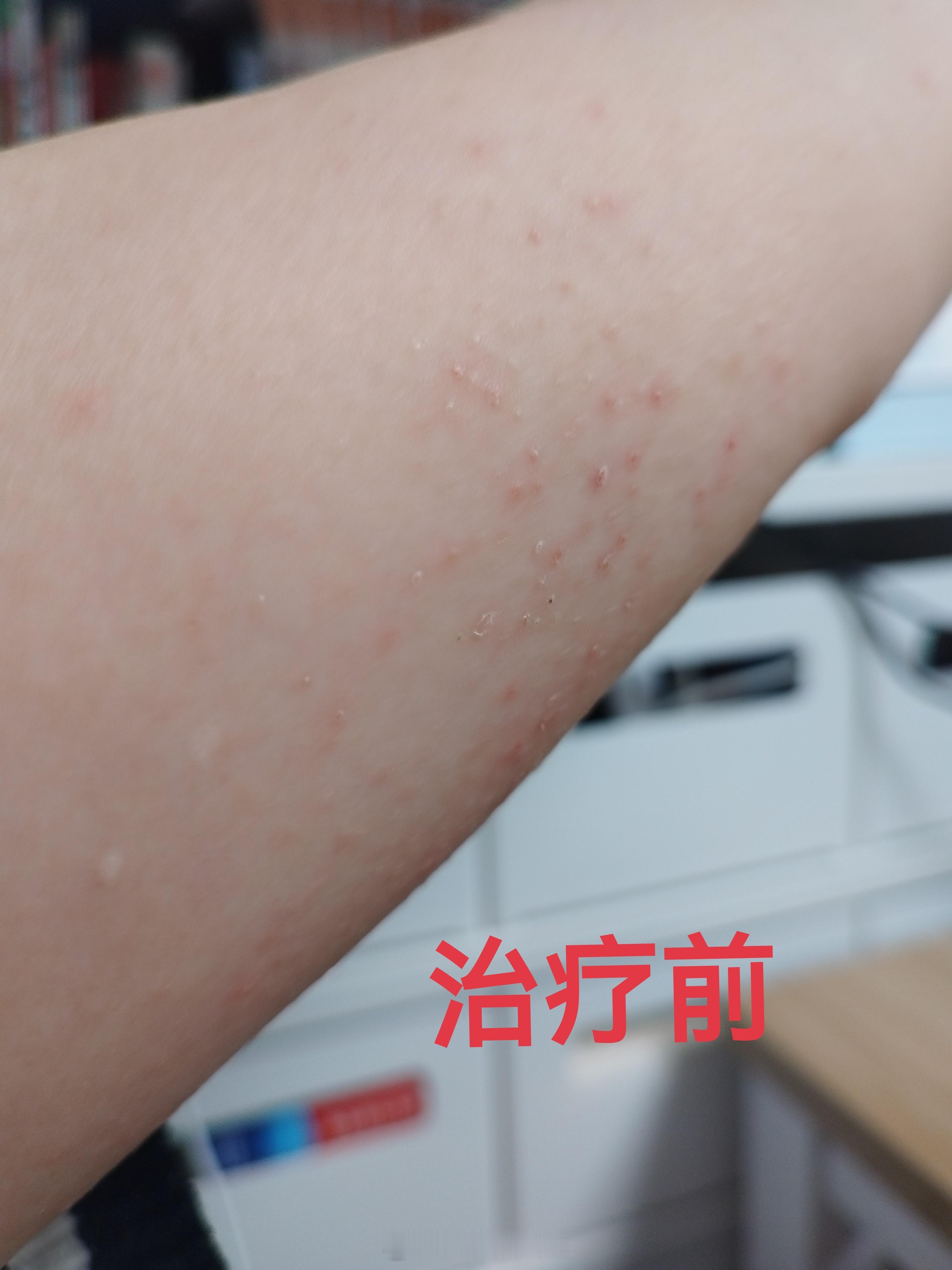 #中医##湿疹# 非常古早的老患者了，吃发物皮肤过敏，爆痒+流黄水，消风散加凉血