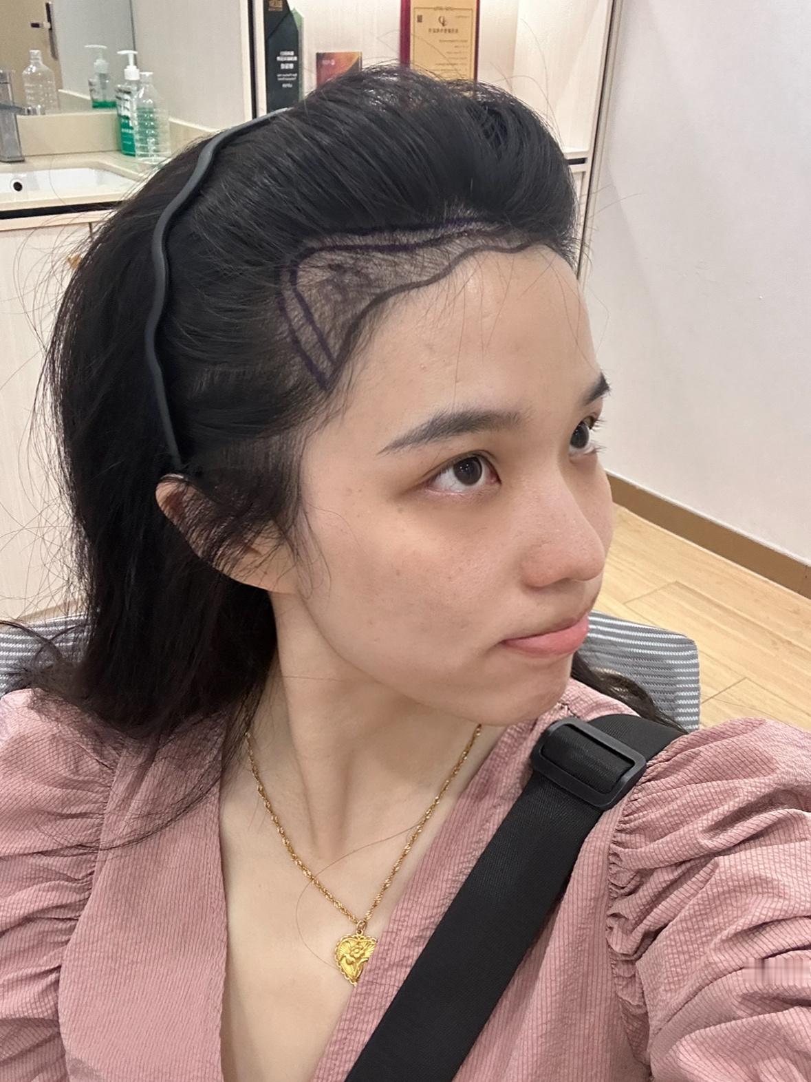发际线最终篇！距离做发际线满一年啦现在的花苞发际线效果真的超出预期 把之前两边的