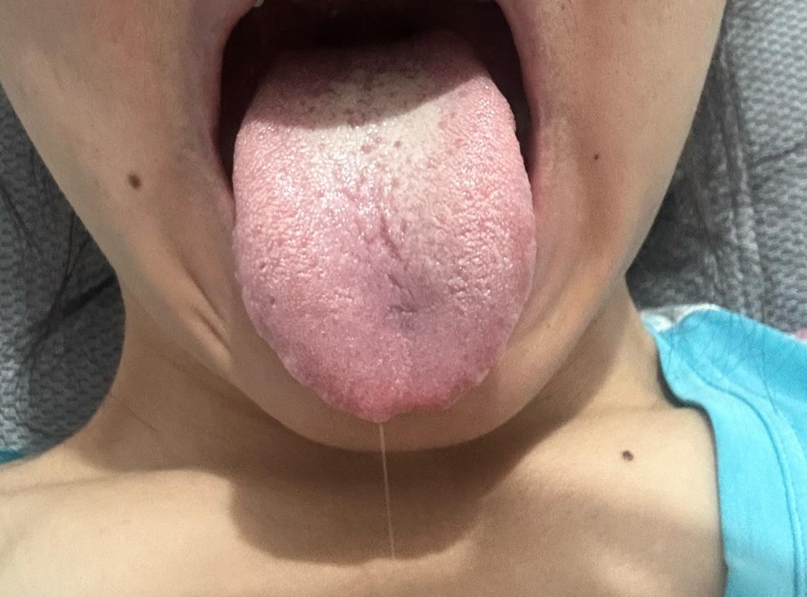 你不像话了！小姑娘才29岁，舌头开裂，舌面一层白苔，小毛病可真不少，脾胃亏虚，肝