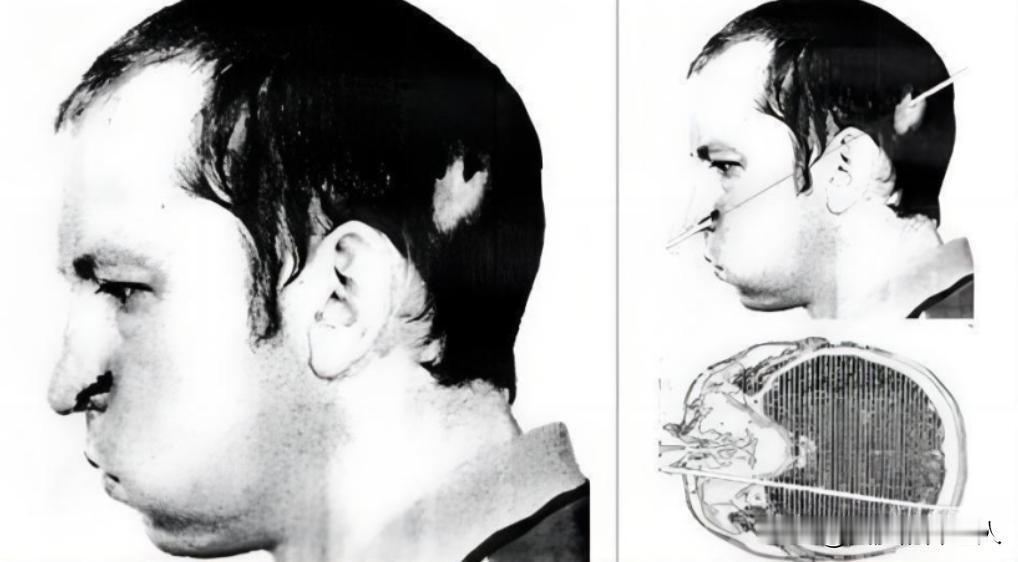 1978年，苏联一位物理学家，不小心被高辐射的粒子光速击穿脑袋，然而，奇迹发生了