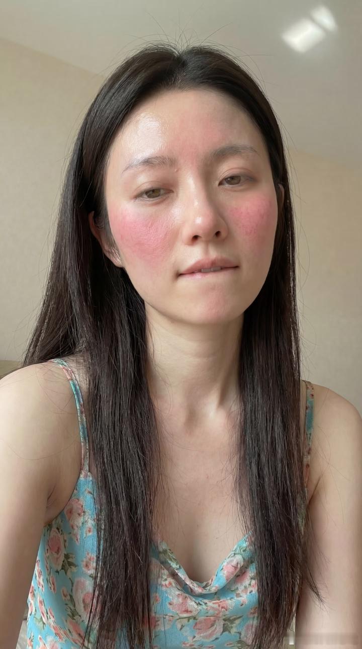 姐姐是过敏了吗？ 脸怎么这么红！ 