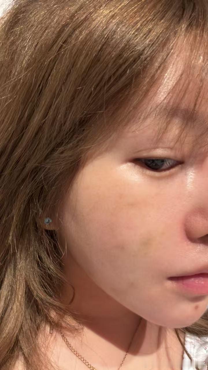 我发现苹果肌这里狂打紧致素➕帝美尼 可以很紧 就是苹果肌紧致大于溶脂 要嘛一次剂