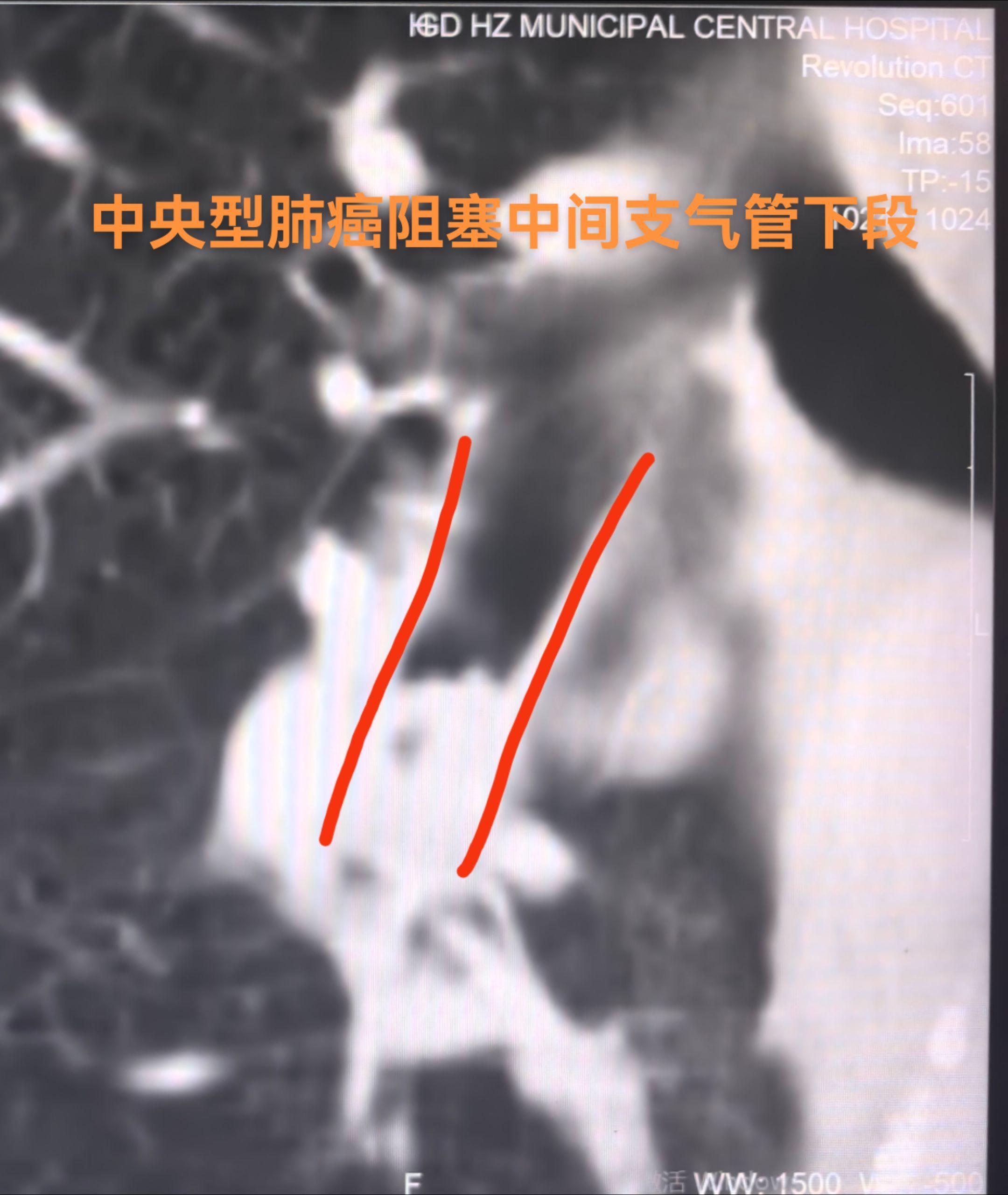 中央型肺癌经气管镜化学消融。