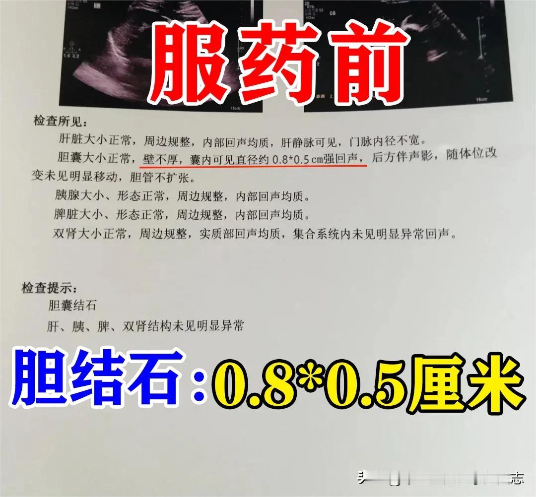 这位患者是一位男性，41岁，体检时发现有结石，多发的，较大者0.8*0.5cm，