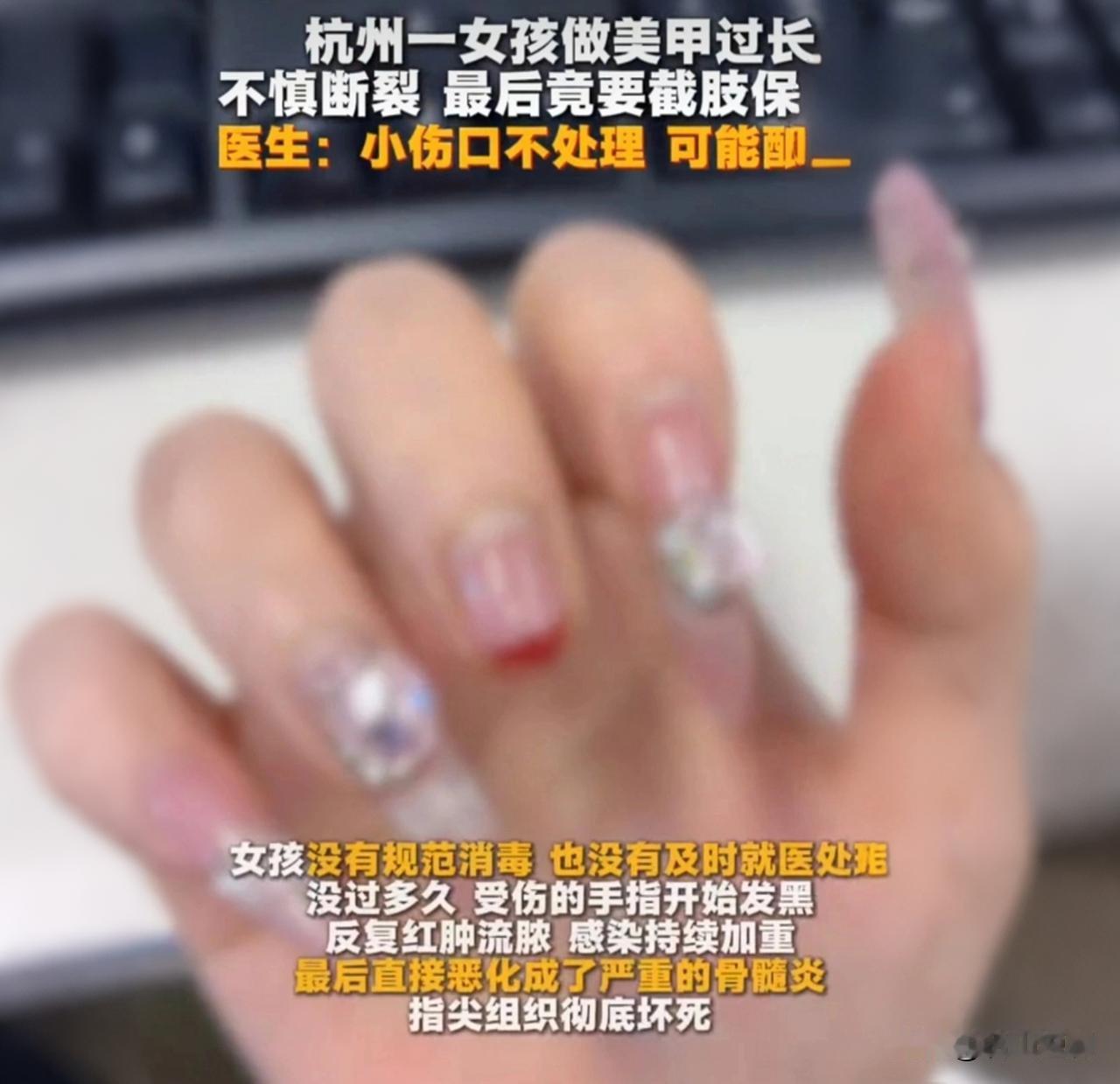 24岁女孩做超长美甲，指甲掀开没当回事，最后惨遭截肢！

看到用户的爱美需求，我