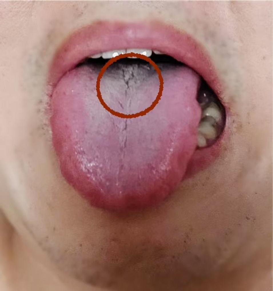 【舌诊分析】小伙肝肾脾同时出问题，看这舌头一定要先调肝！

患者自述总是觉得手脚
