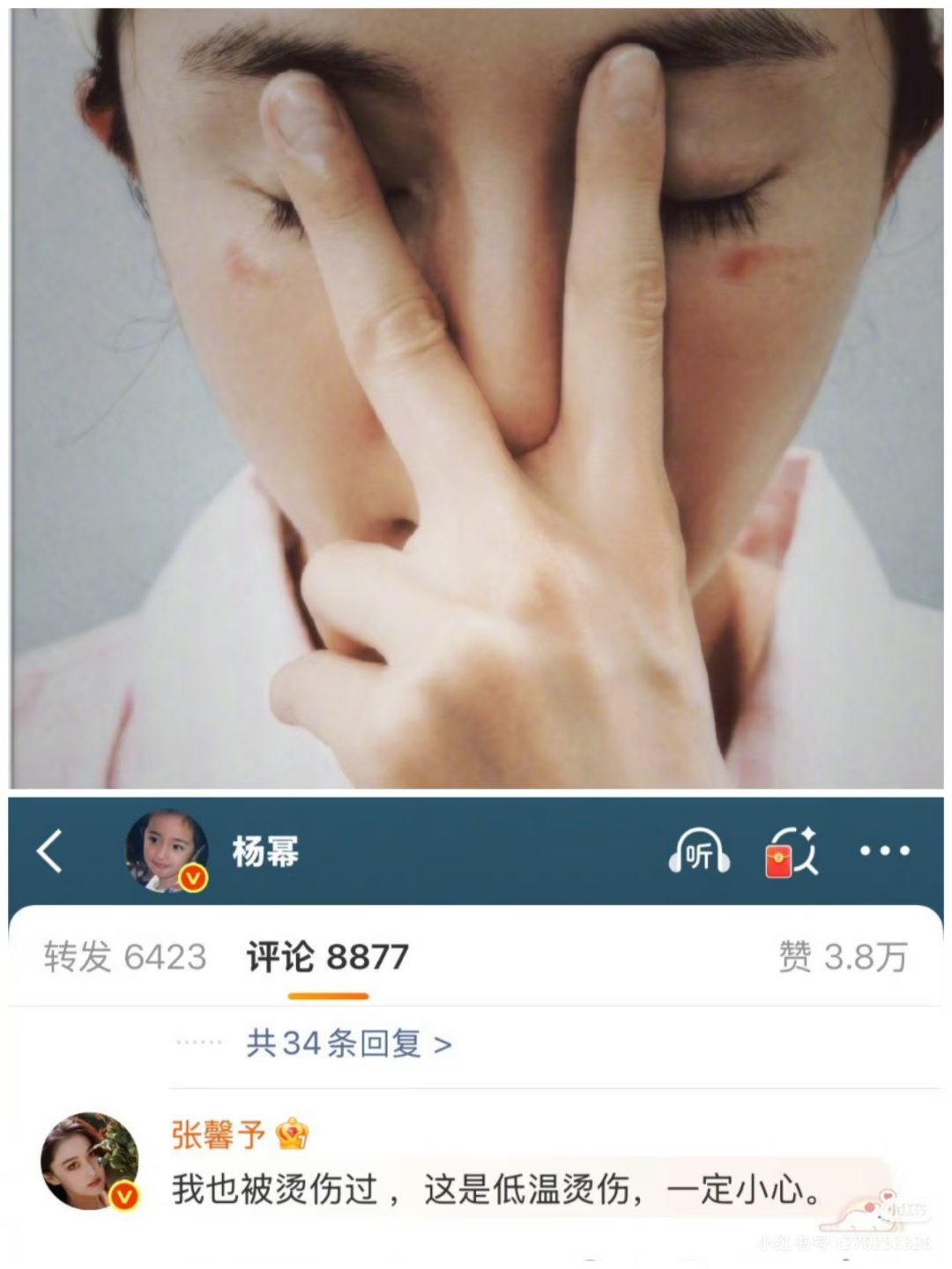 张馨予也被蒸汽眼罩烫伤过眼睛喜凉不喜热啊姐妹们！！冰敷才是正确的放松眼睛的办法！