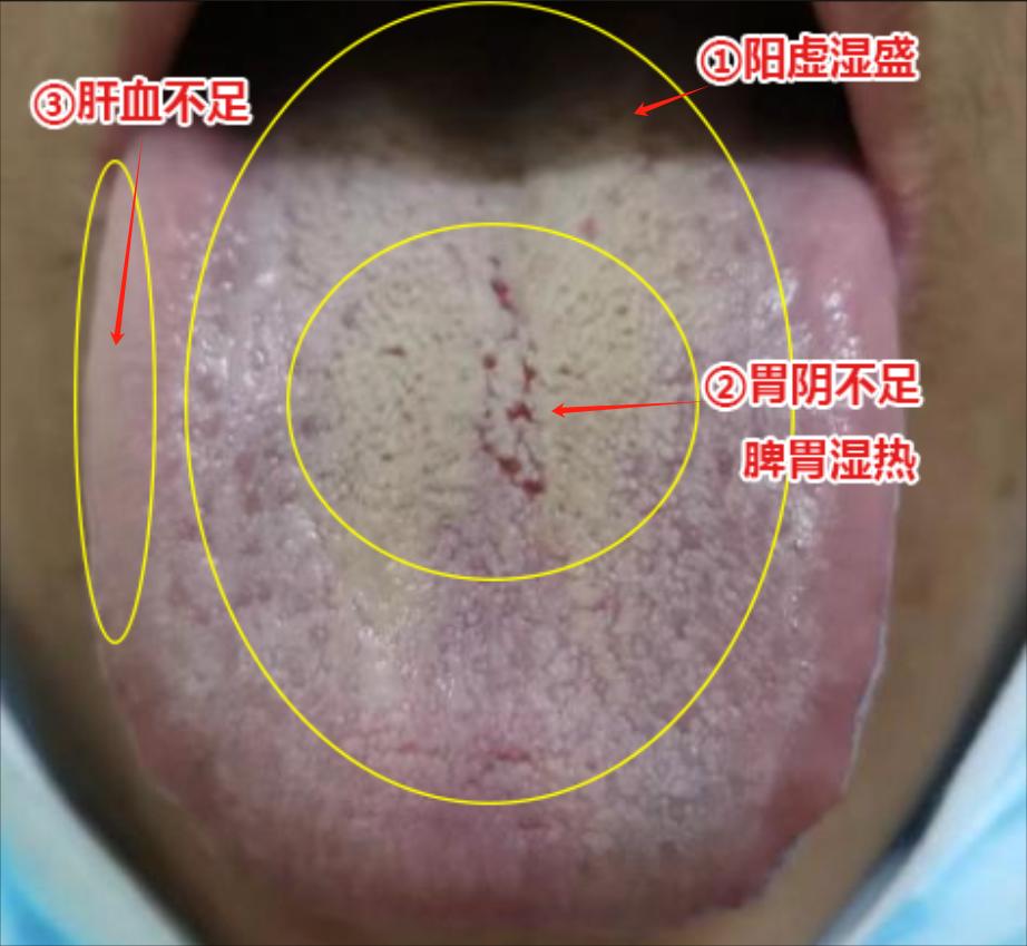 肾虚，敏感，容易倒戈，吃了补肾阳都没有用，原因就在这！
患者主诉：敏感，容易倒戈