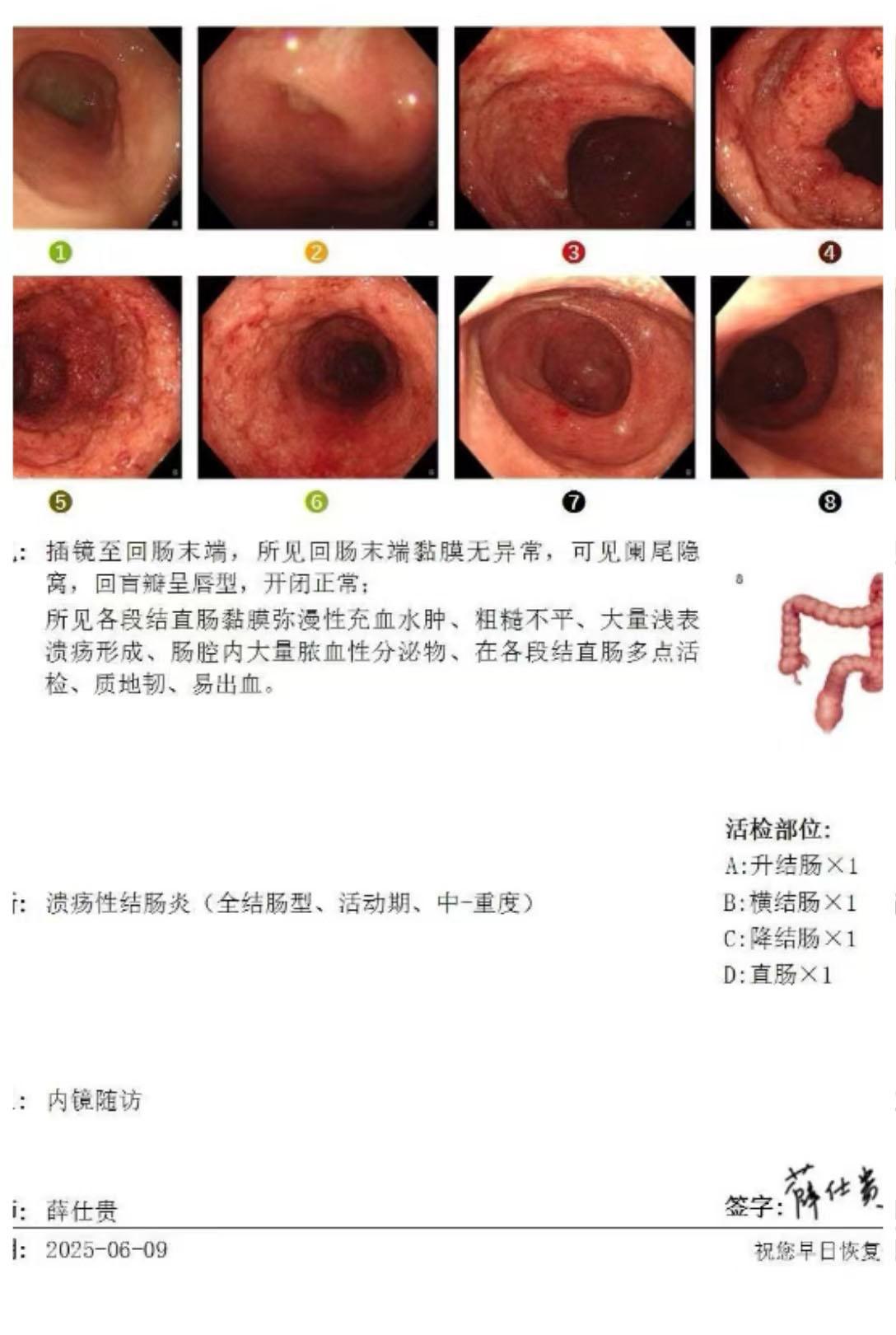 重度溃结好转，关键在 “不擅自停药”！。重度溃结反复便血！遇顾思臻主任...