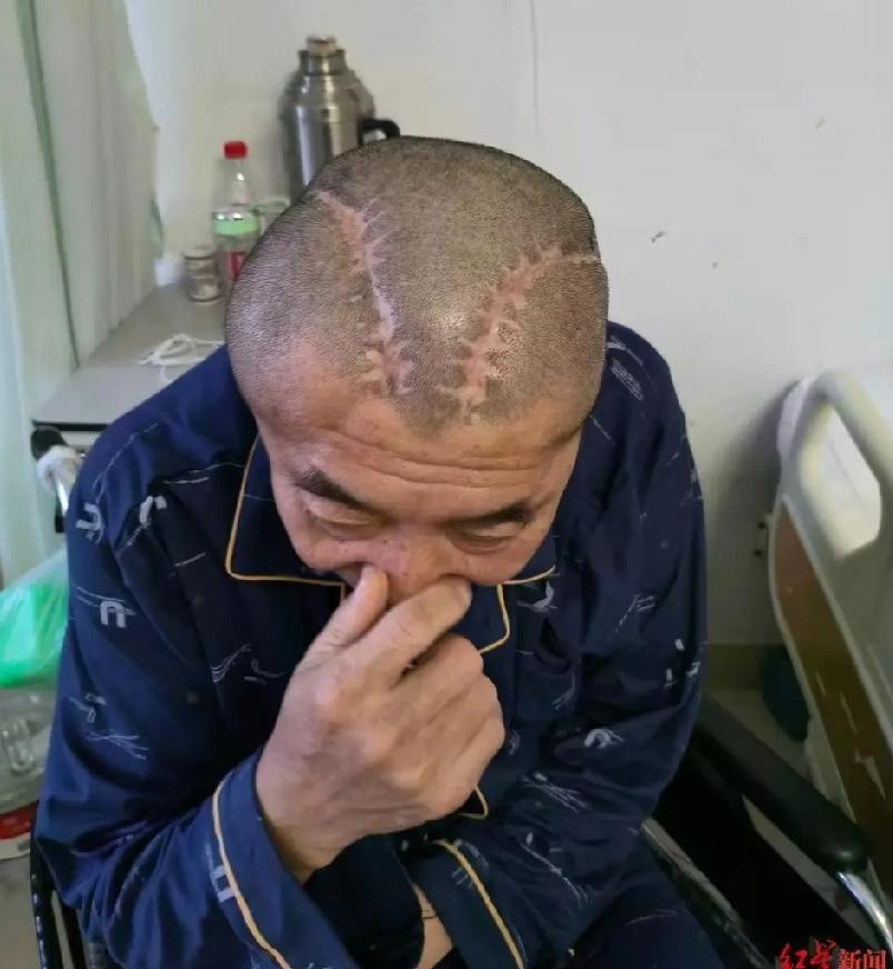 头颅手术大意到不分左右
包头市的王先生在家中卫生间摔伤头部，在包头市中心医院就医