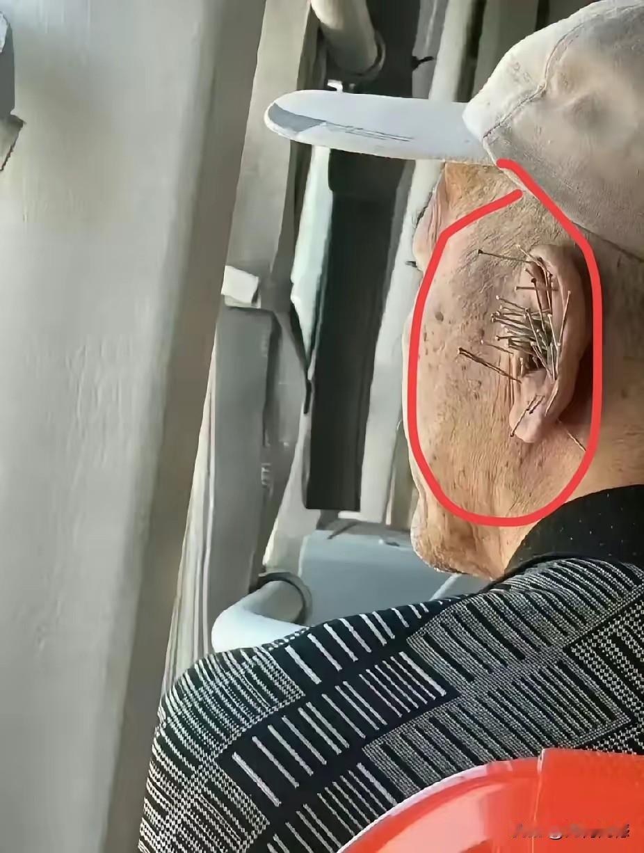 这个老人的耳朵应该是做的针灸，不过这些针扎的有些过密集了，也许这是根据病情的需要